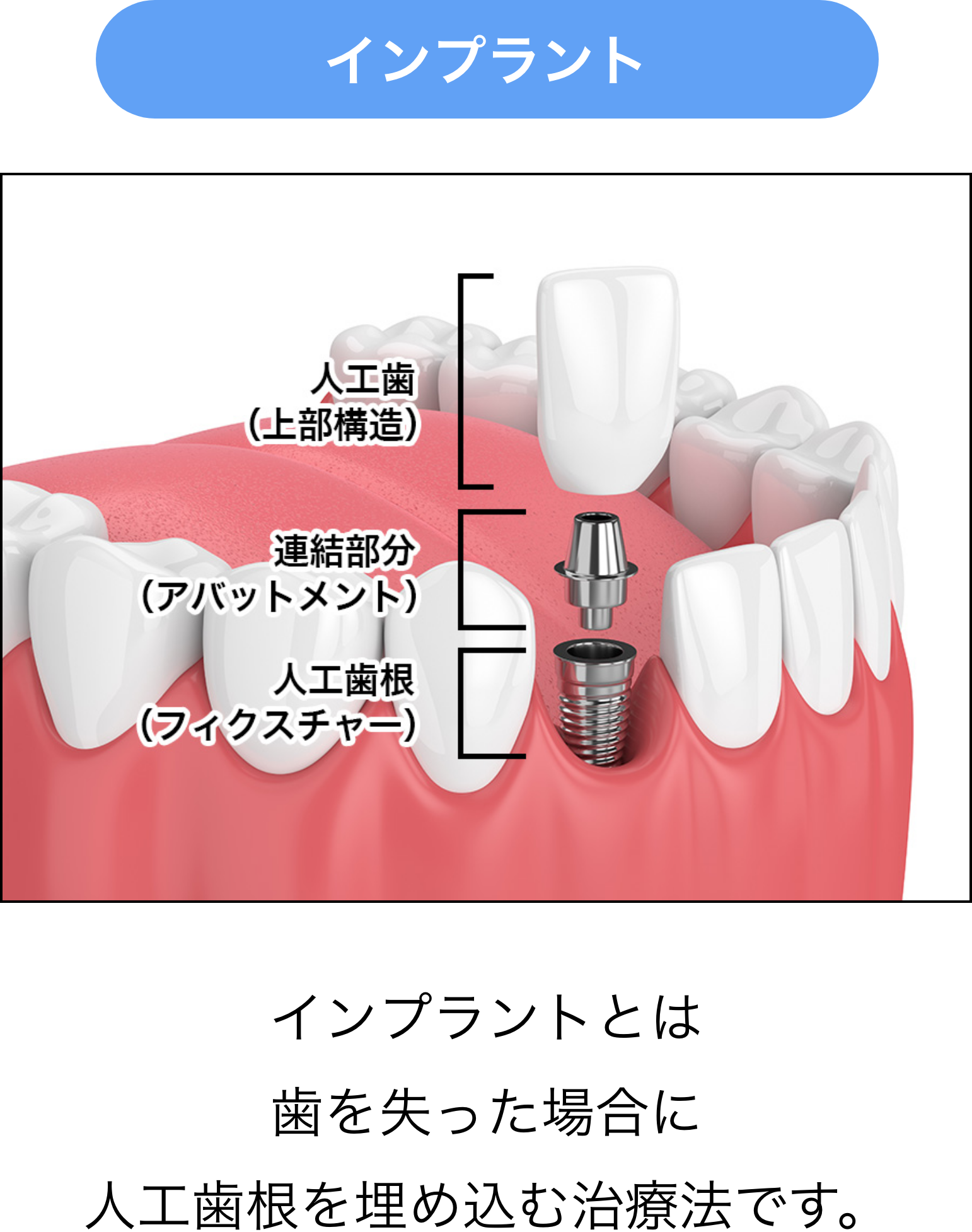 インプラントとは歯を失った場合に人工歯根を埋め込む治療法です。